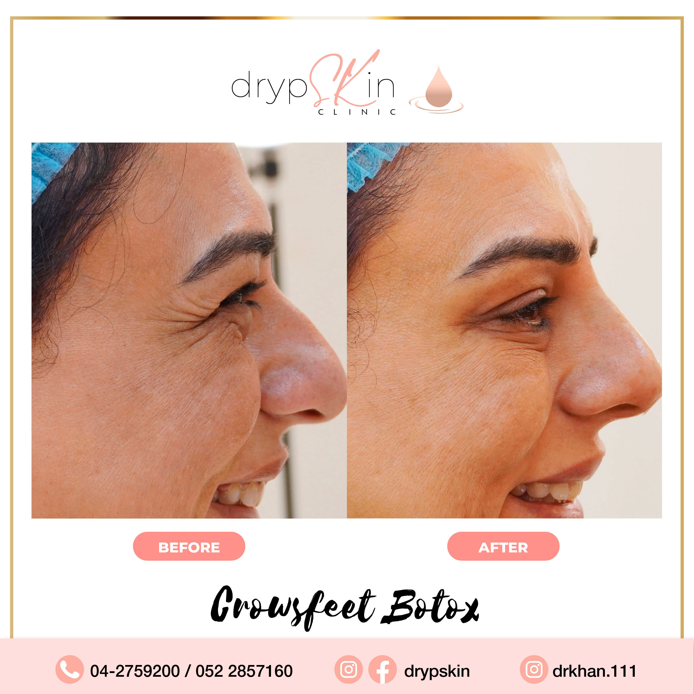 Botox Dubai Botox Injection Dubai Botox Clinic