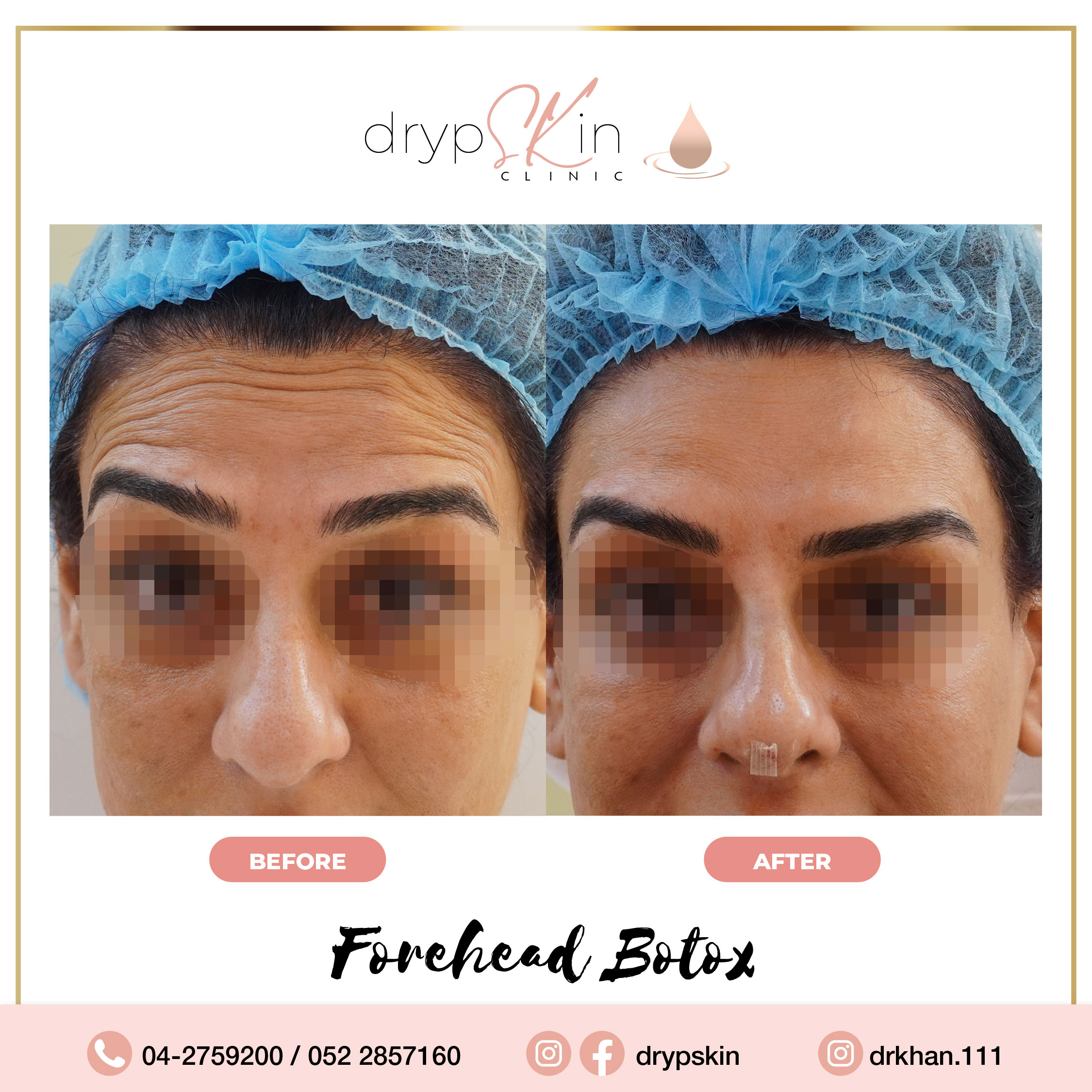 Botox Dubai Botox Injection Dubai Botox Clinic