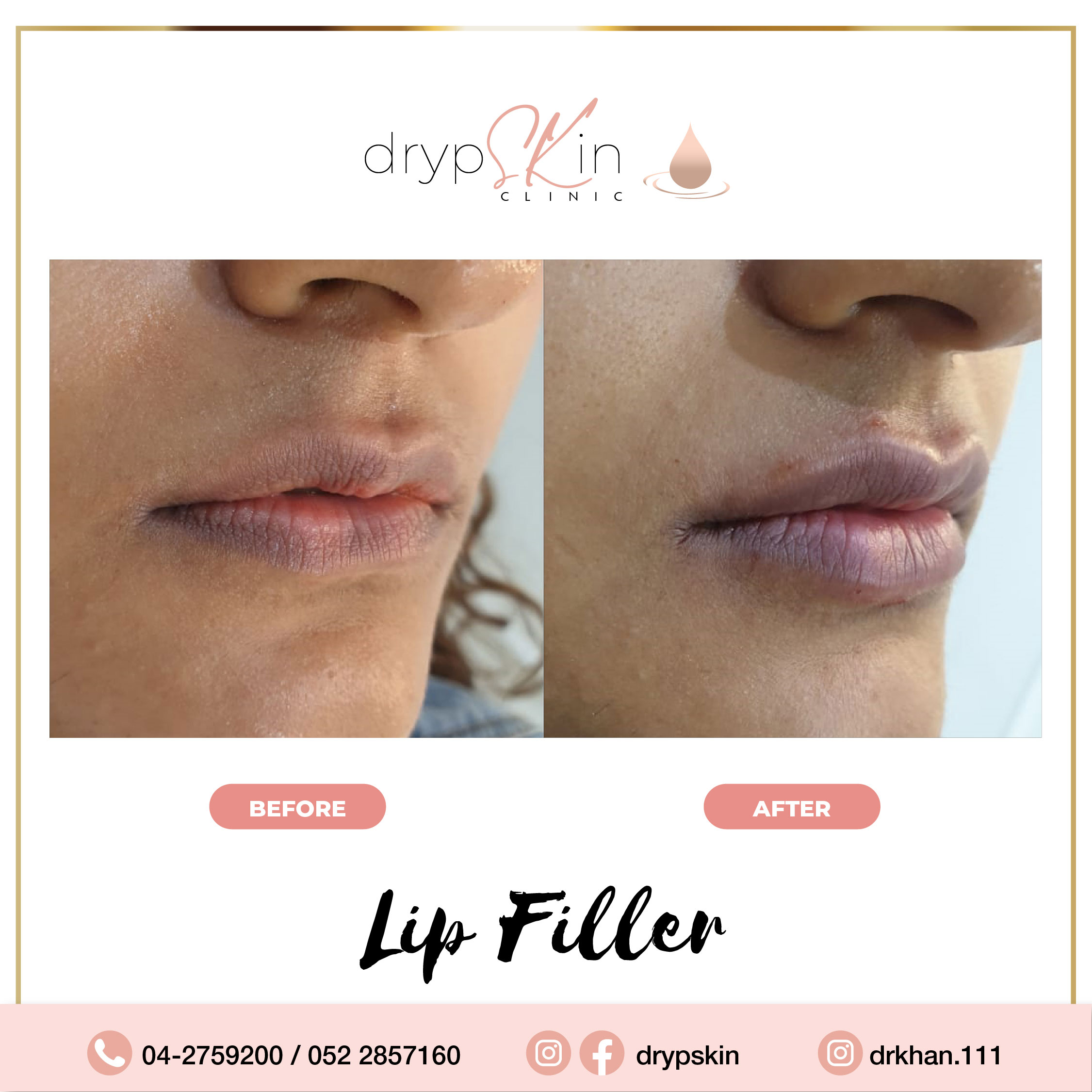 Dermal Fillers SHOCKING Transformation!