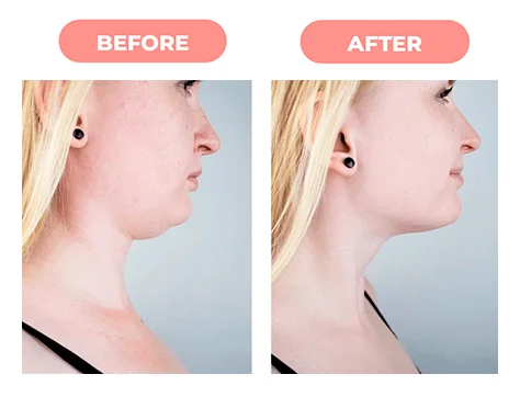 Double Chin Removal Dubai