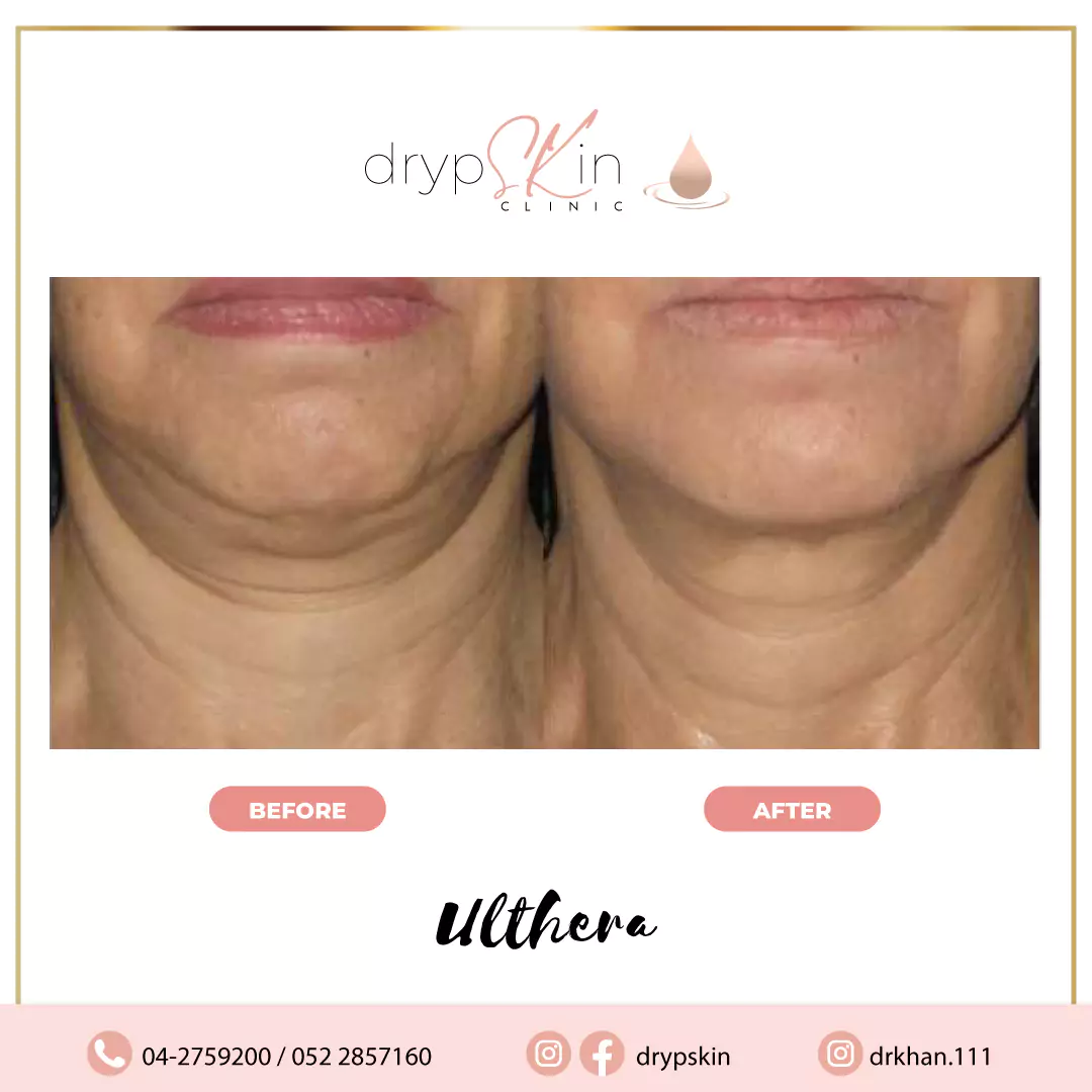 facelift treatments gallery12