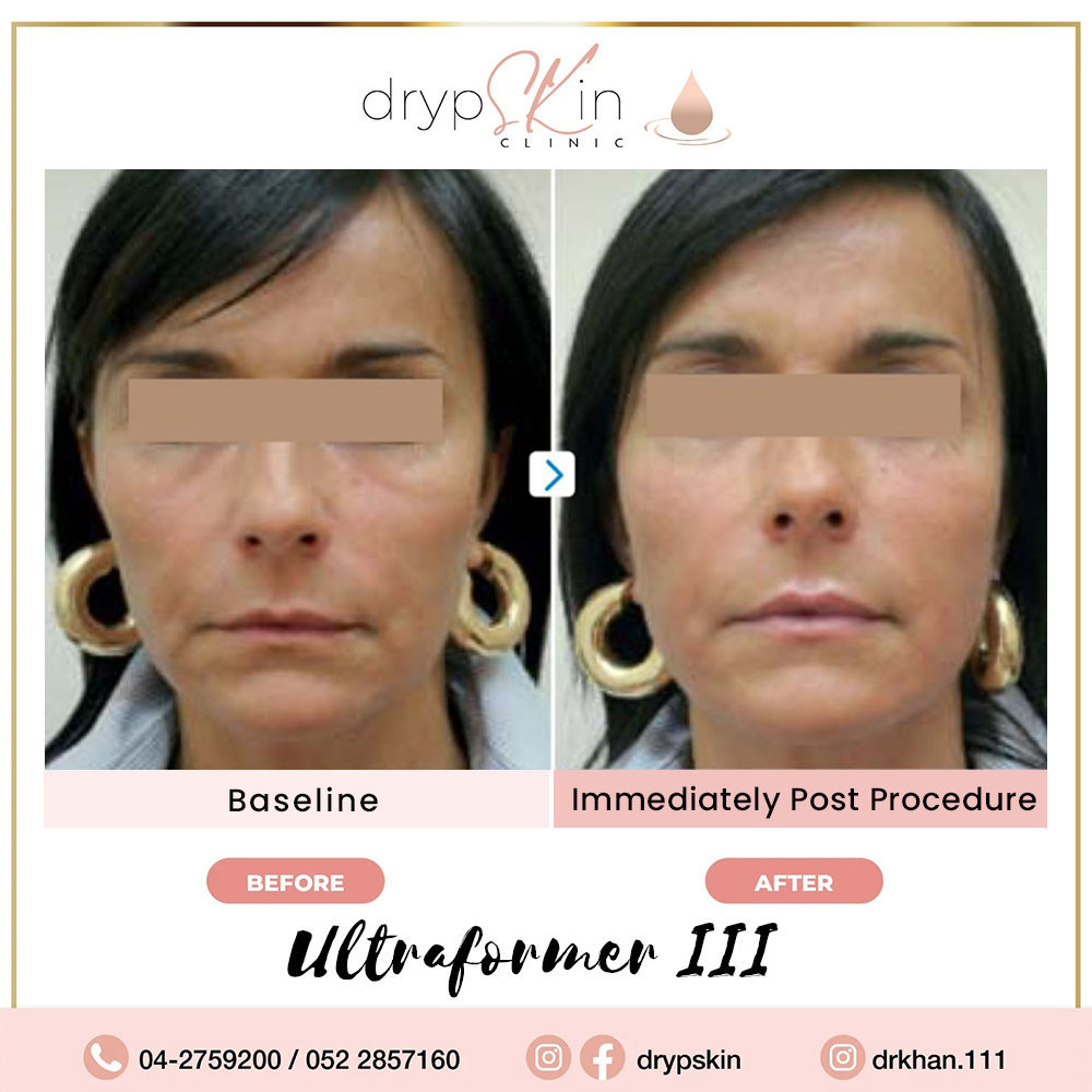 facelift treatments gallery14