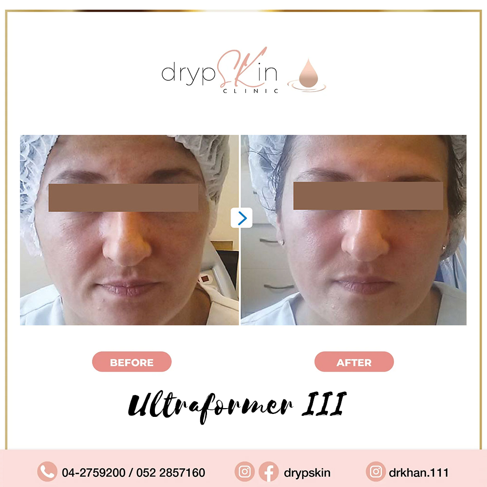 facelift treatments gallery14