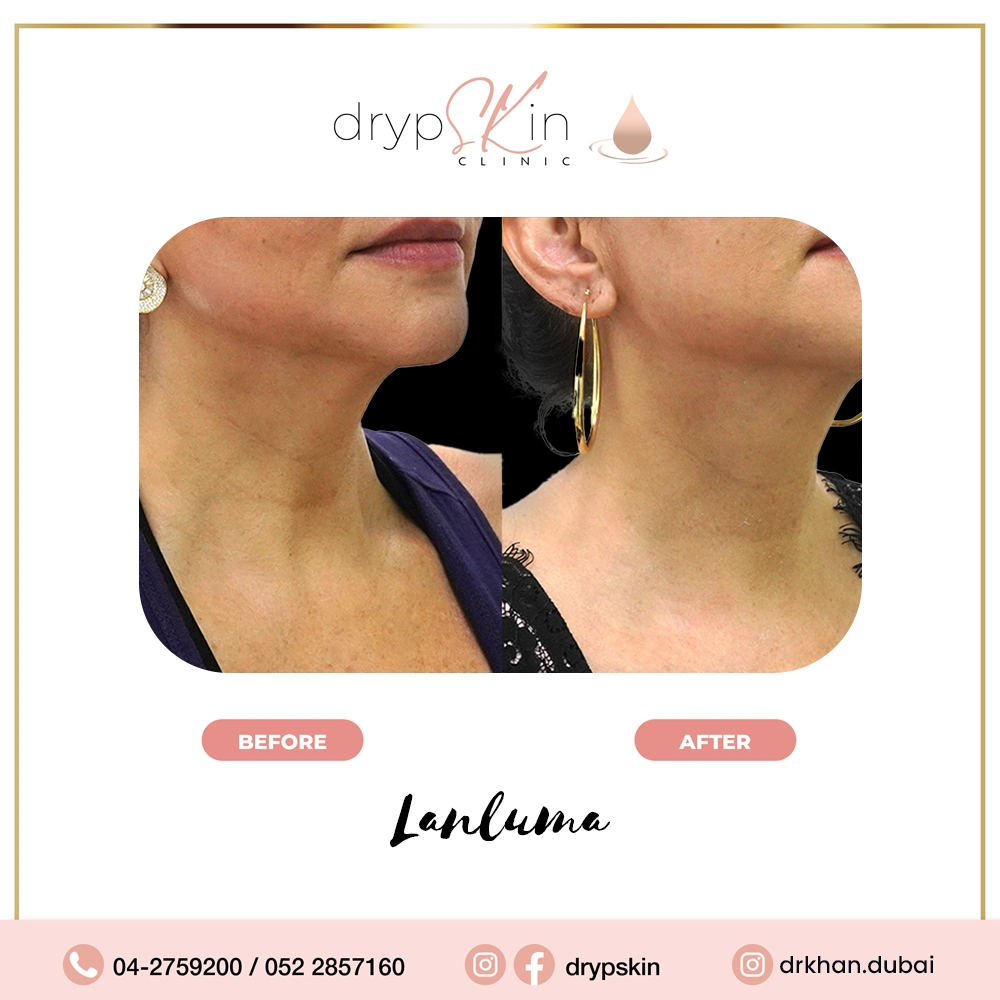 forehead-botox-dubai