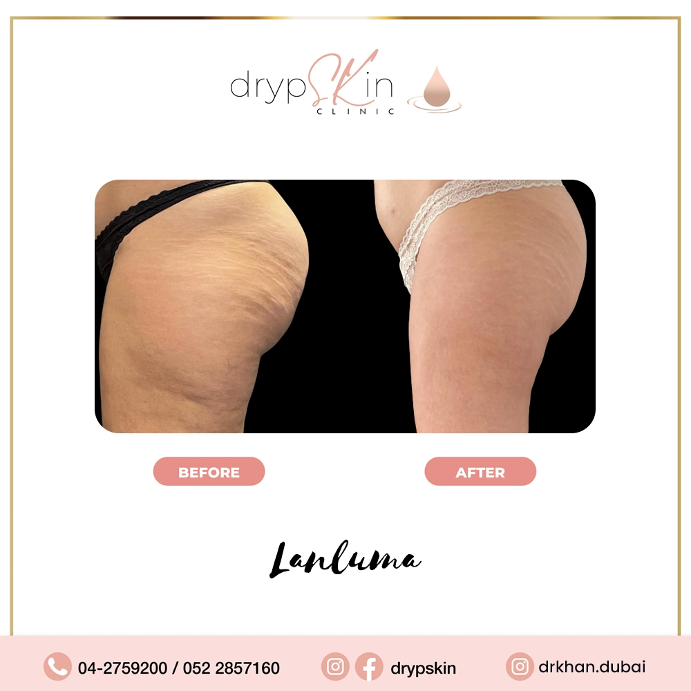 forehead-botox-dubai