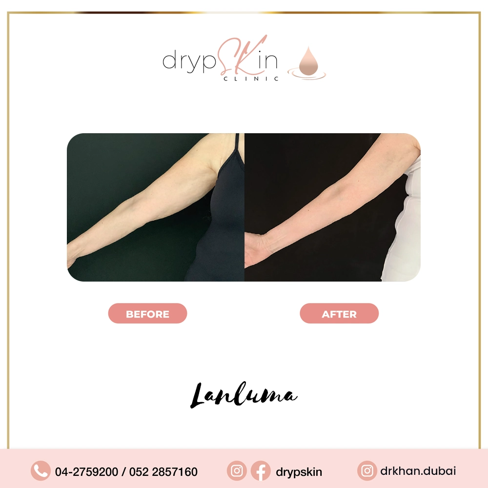 forehead-botox-dubai