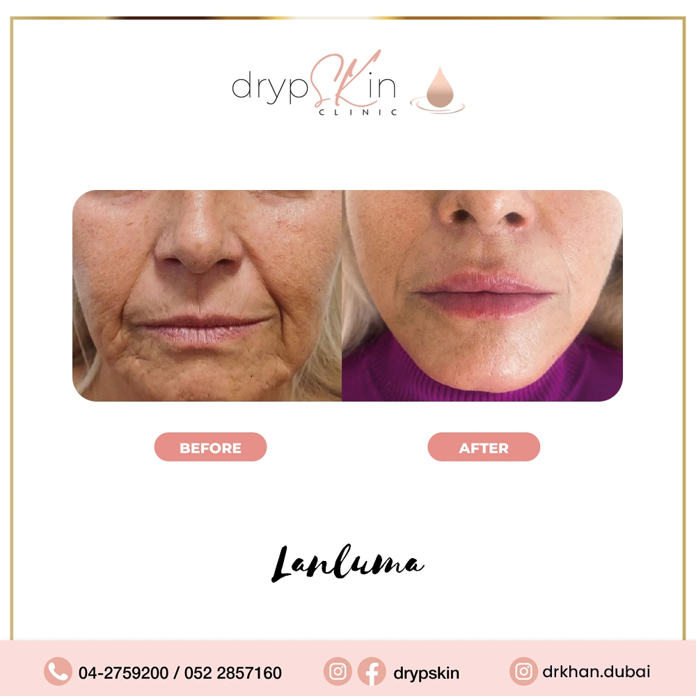 forehead-botox-dubai