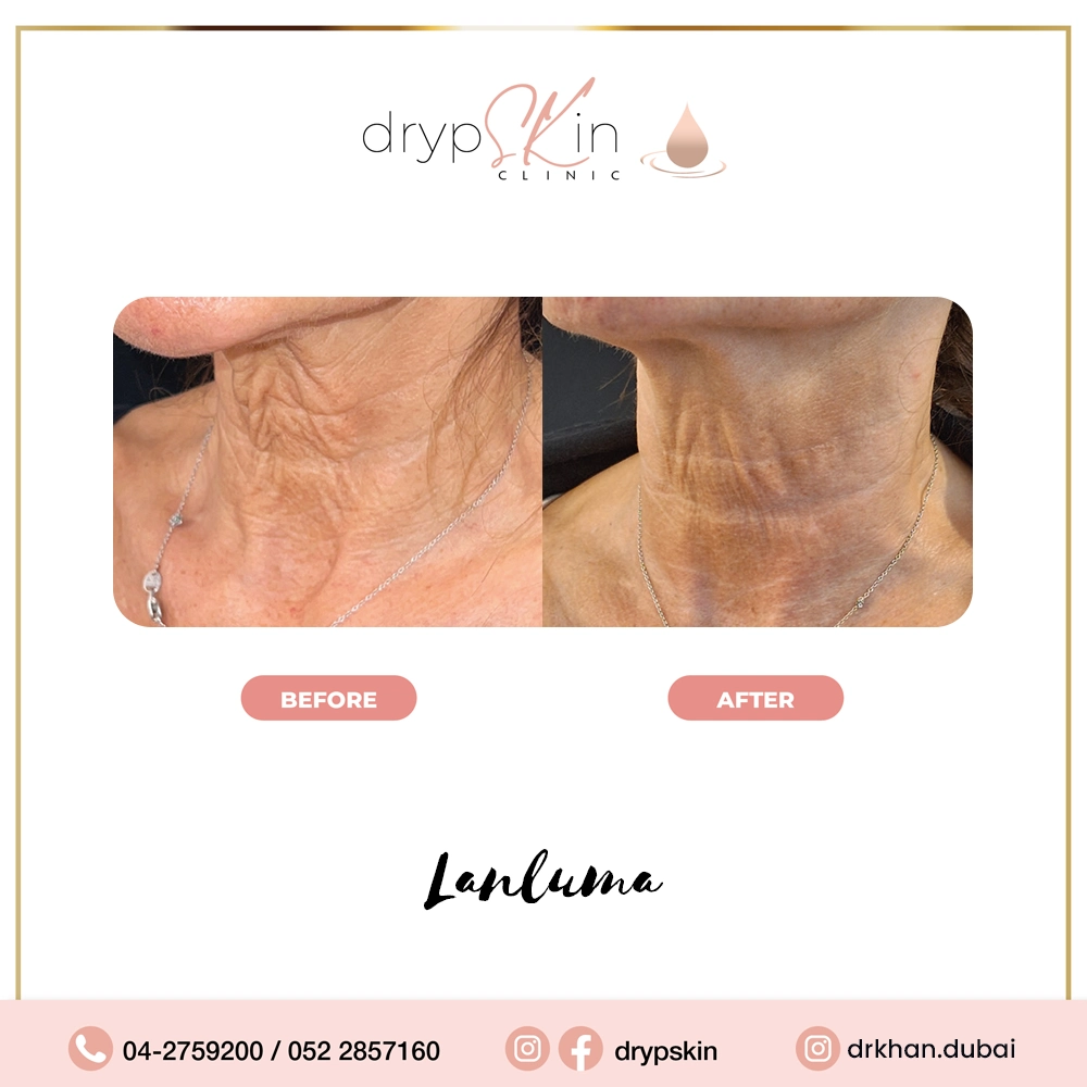 forehead-botox-dubai