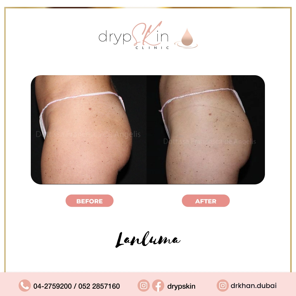 forehead-botox-dubai