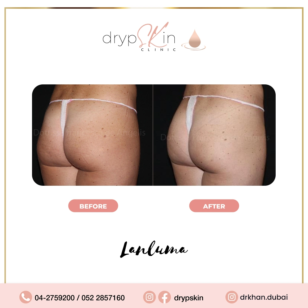 forehead-botox-dubai