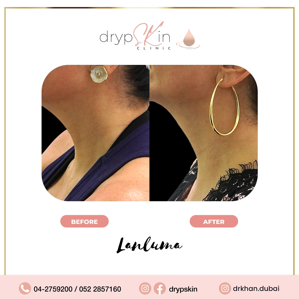 forehead-botox-dubai