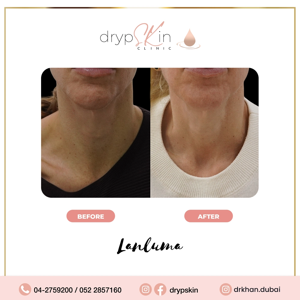 forehead-botox-dubai