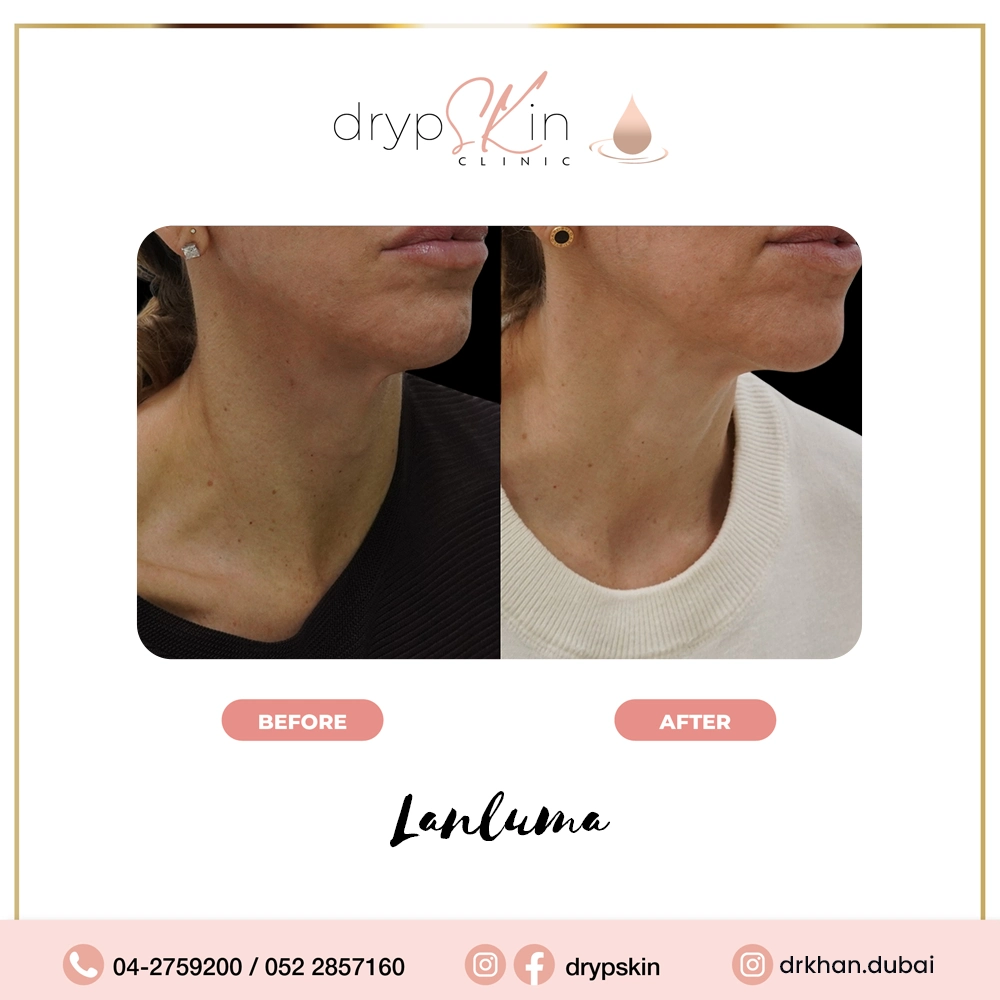 forehead-botox-dubai