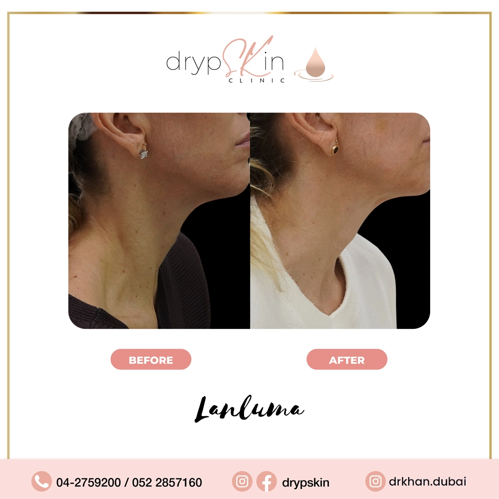 forehead-botox-dubai