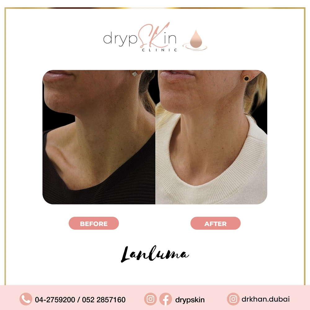 forehead-botox-dubai