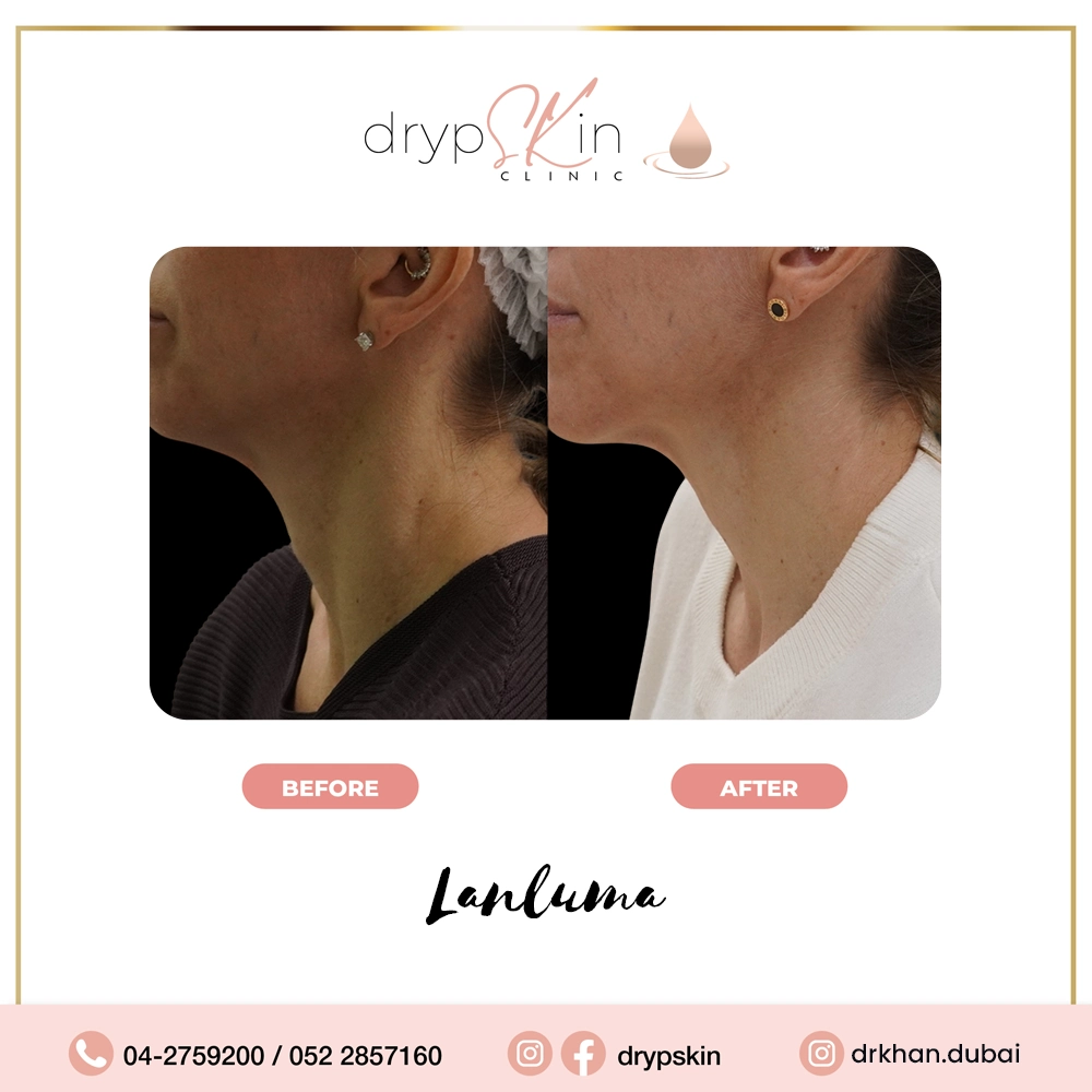 forehead-botox-dubai