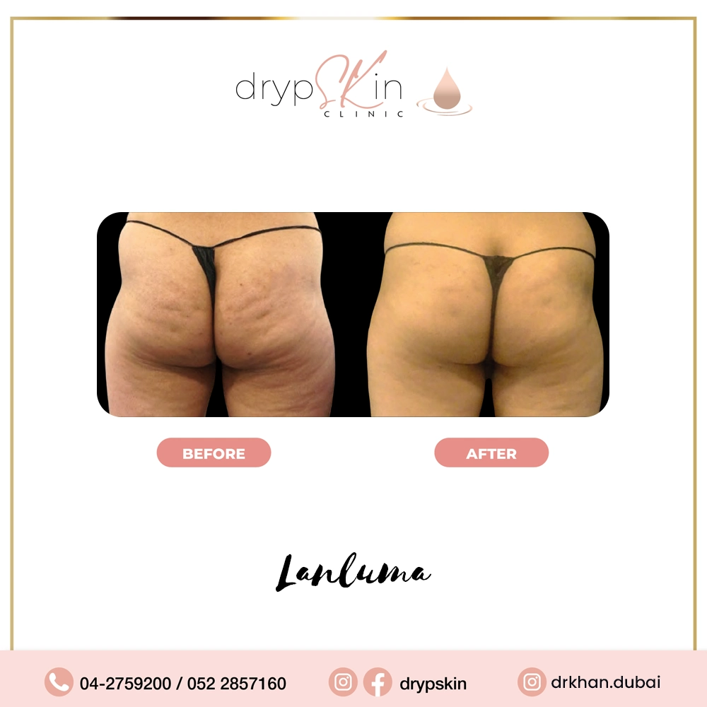 forehead-botox-dubai