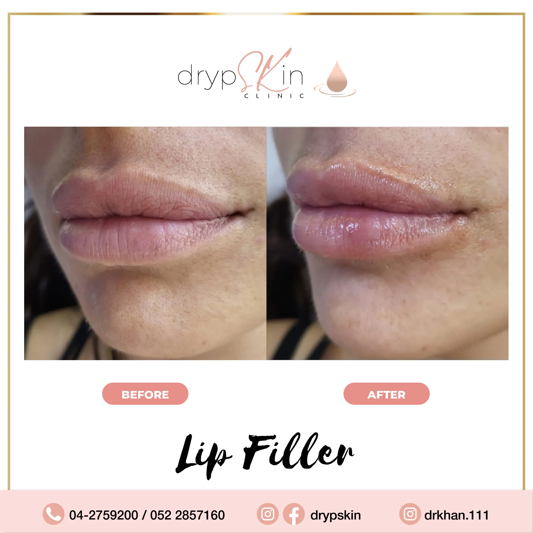 lip filler before after 13