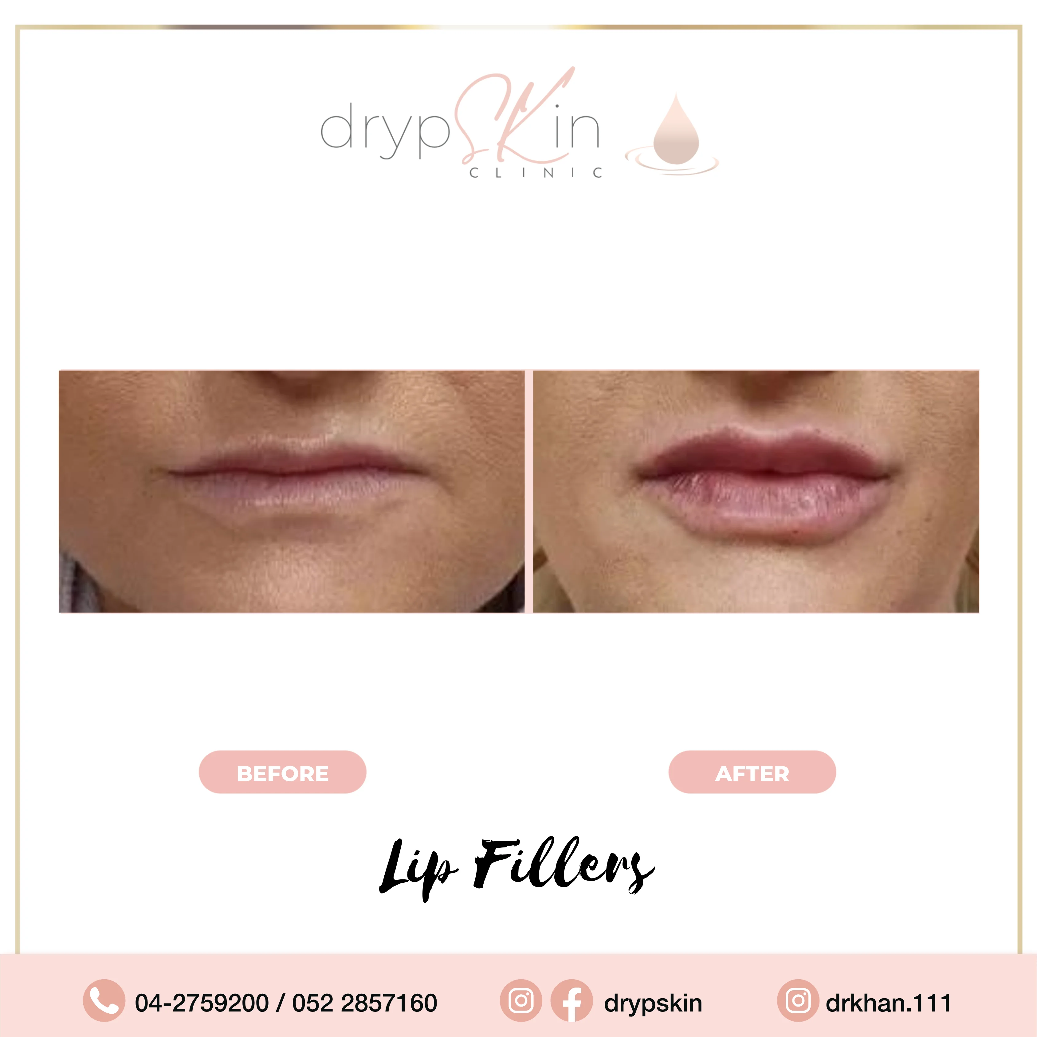 lip filler before after 1