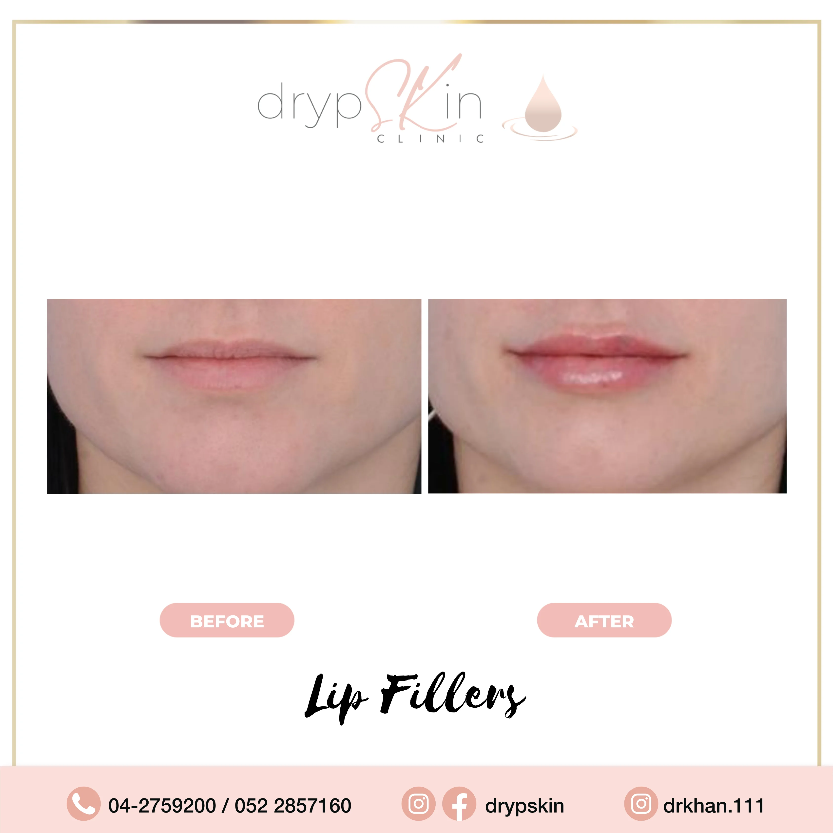 lip filler before after 2