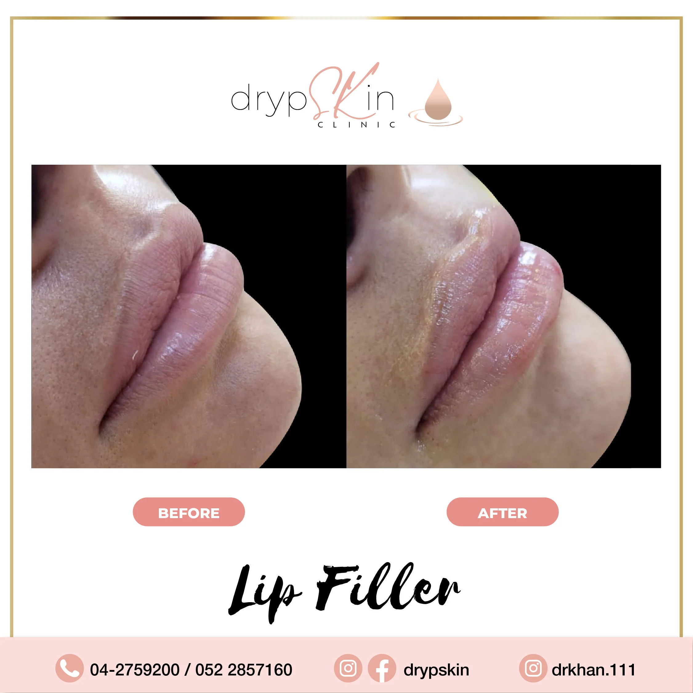 lip filler before after 2