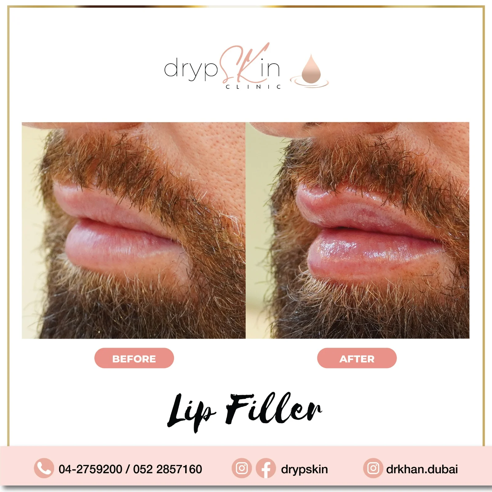lip filler before after 9
