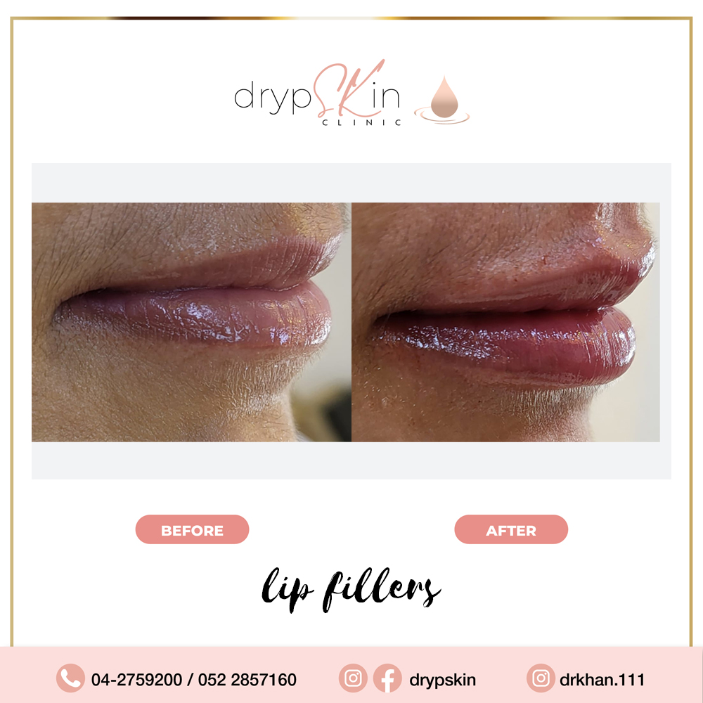Lip filler Dubai Russian Lip Fillers Drypskin