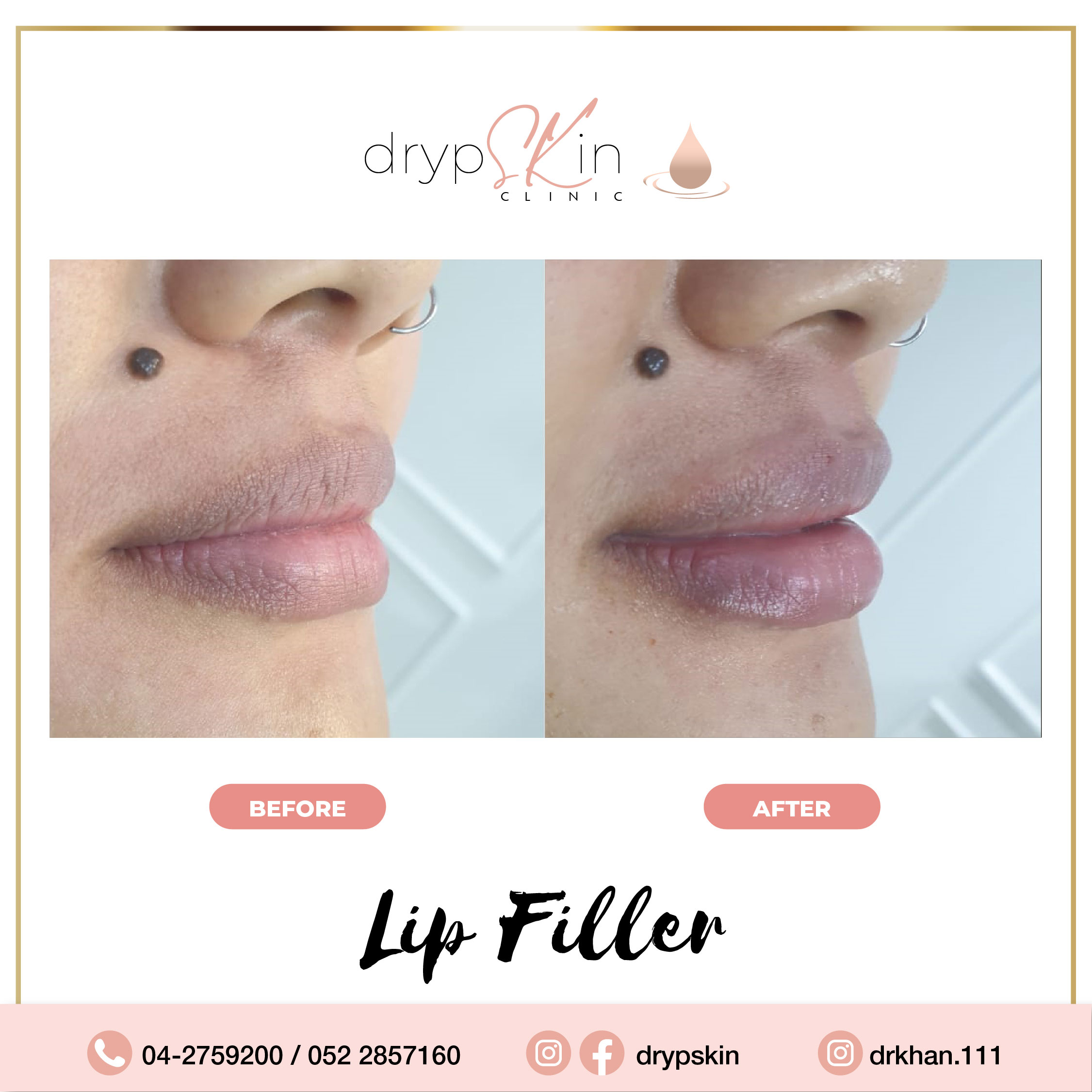 Lip filler Dubai Russian Lip Fillers Drypskin