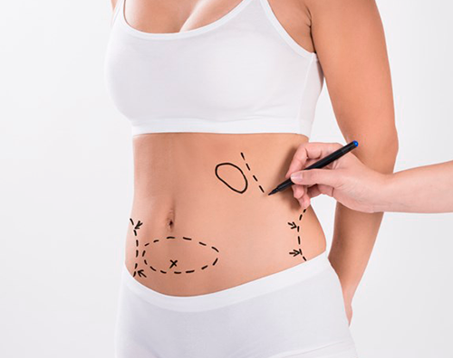 Who is Abdominoplasty For