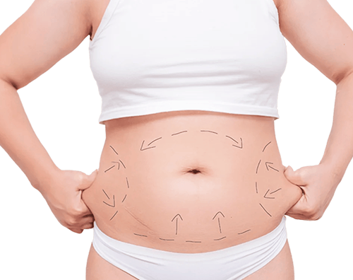 Who is Abdominoplasty For