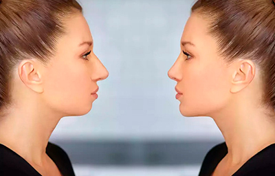 Non-surgical Chin Lift