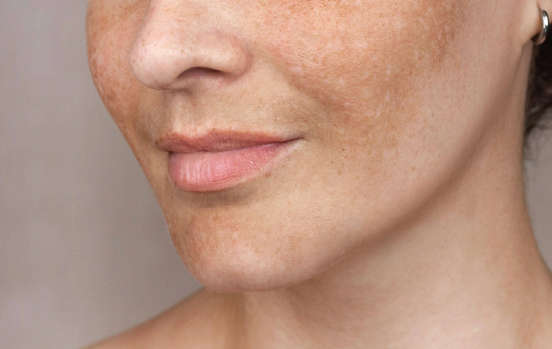 Melasma: Why It Keeps Coming Back (And What Actually Helps)